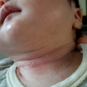 乳児湿疹　首