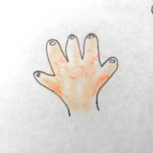 子供の手にぶつぶつができて痒そう!砂かぶれ様皮膚炎