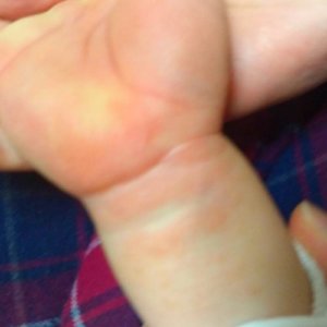 子供の手にぶつぶつでかゆい砂かぶれ様皮膚炎5