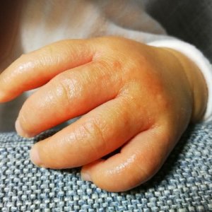 子供の手にぶつぶつでかゆい砂かぶれ様皮膚炎4