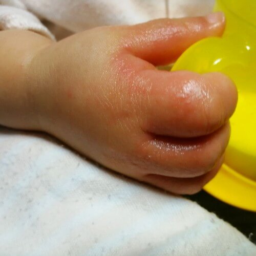 子供の手にぶつぶつでかゆい砂かぶれ様皮膚炎6