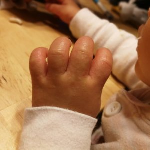子供 手 ぶつぶつ 砂かぶれ様皮膚炎