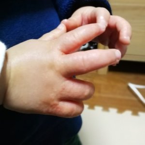 子供の手にぶつぶつで痒い!砂かぶれ様皮膚炎