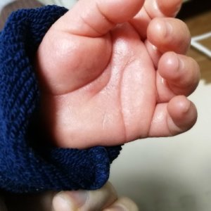 子供の手のひらにぶつぶつができてかゆい!砂かぶれ様皮膚炎