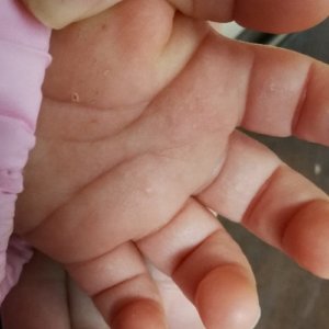 手のひらにぶつぶつ!砂かぶれ様皮膚炎手のひら2