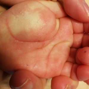 手のひらぶつぶ子供 砂かぶれ様皮膚炎