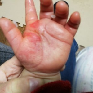 砂かぶれ様皮膚炎で手が真っ赤