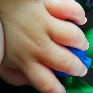 砂かぶれ様皮膚炎で手がぶつぶつでかゆい