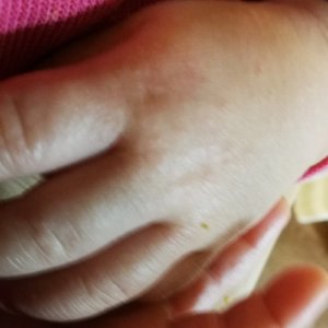 砂かぶれ様皮膚炎で手がぶつぶつ
