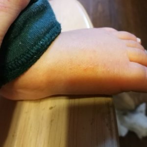 子供の足にぶつぶつが!砂かぶれ様皮膚炎