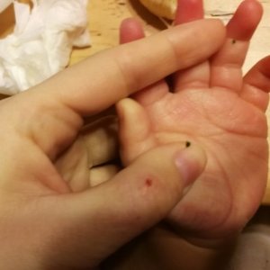 砂かぶれ様皮膚炎のその後