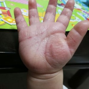 砂かぶれ様皮膚炎で割れた手