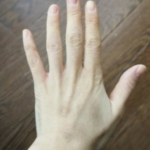 手のアトピー きれいになった